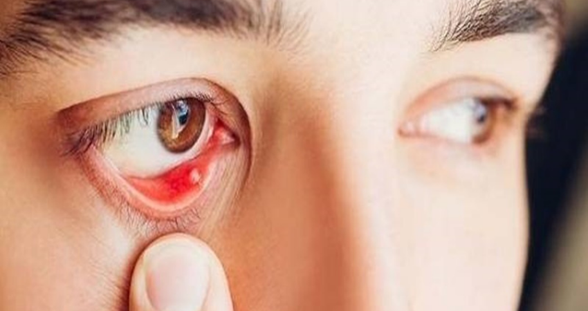 sạn vôi ở mắt